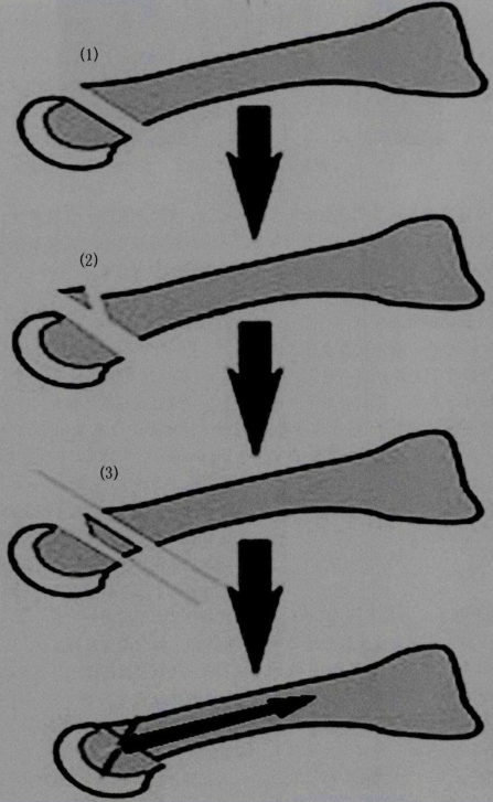 akin截骨术示意图图片