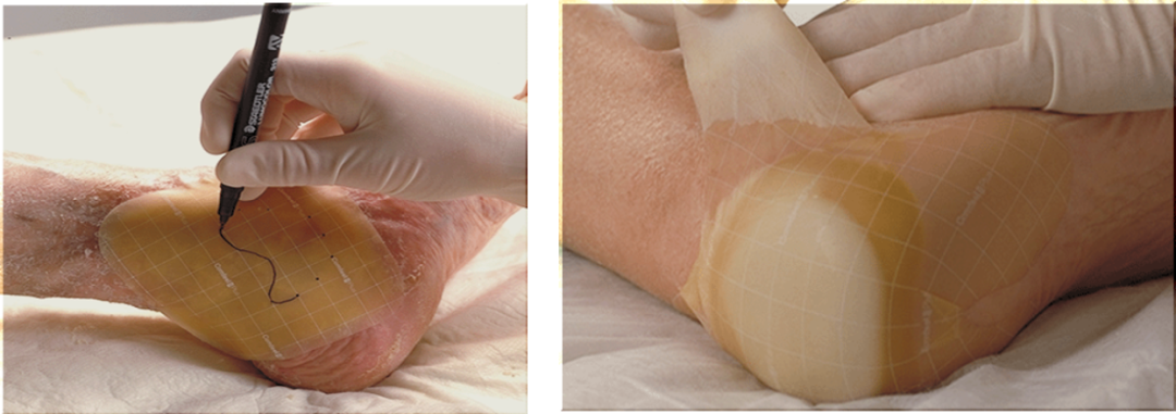 人工敷料怎么照顾伤口伤口分类及护理原则（五）：敷料的选择和选分类_https://www.jmylbn.com_新闻资讯_第10张