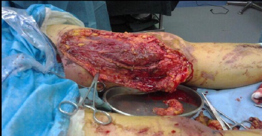 为什么负压引流骨科精读 ｜ 骨科常用的负压封闭引流术，一文读懂！_https://www.jmylbn.com_新闻资讯_第8张