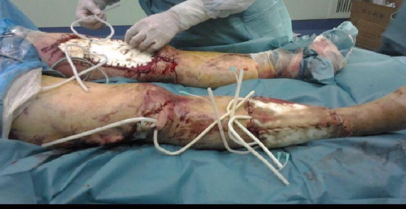 为什么负压引流骨科精读 ｜ 骨科常用的负压封闭引流术，一文读懂！_https://www.jmylbn.com_新闻资讯_第13张