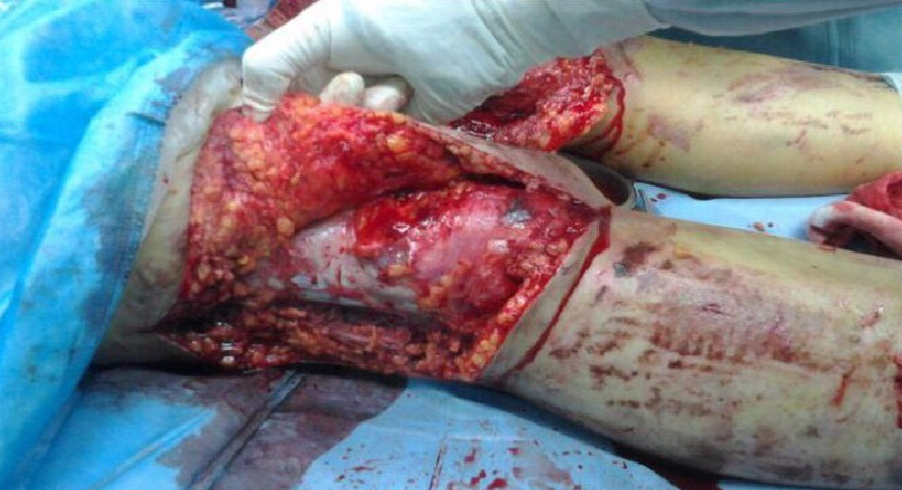 为什么负压引流骨科精读 ｜ 骨科常用的负压封闭引流术，一文读懂！_https://www.jmylbn.com_新闻资讯_第10张