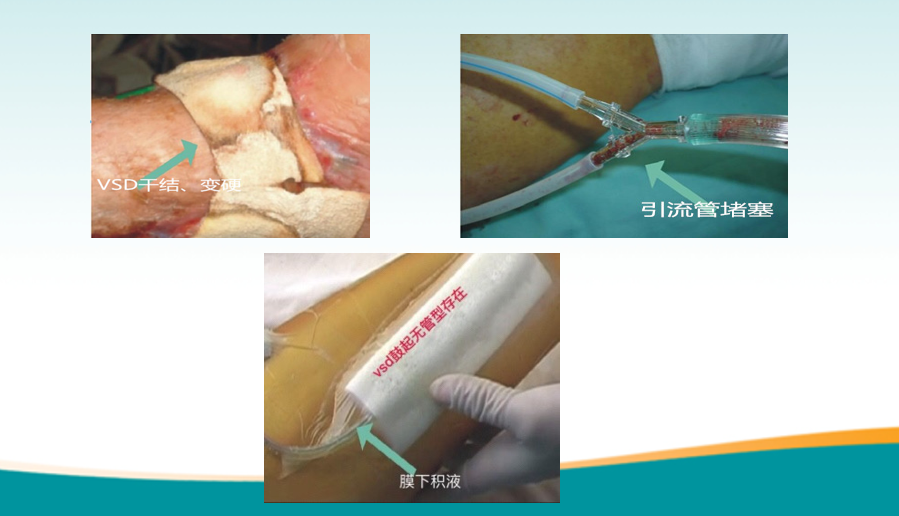 为什么负压引流骨科精读 ｜ 骨科常用的负压封闭引流术，一文读懂！_https://www.jmylbn.com_新闻资讯_第7张