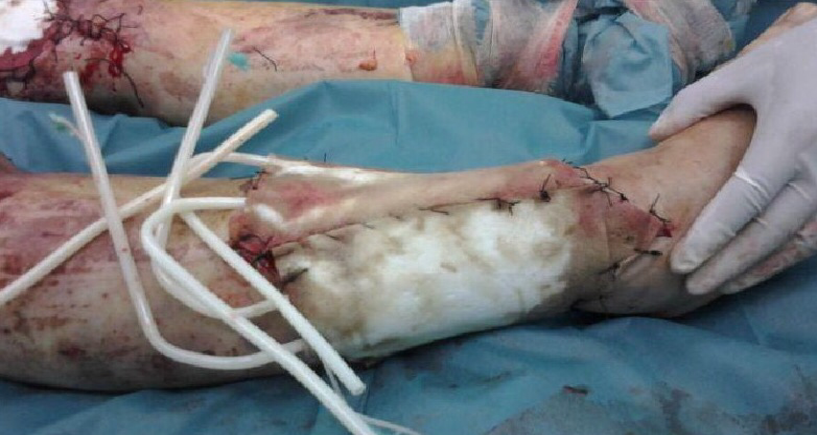 为什么负压引流骨科精读 ｜ 骨科常用的负压封闭引流术，一文读懂！_https://www.jmylbn.com_新闻资讯_第12张