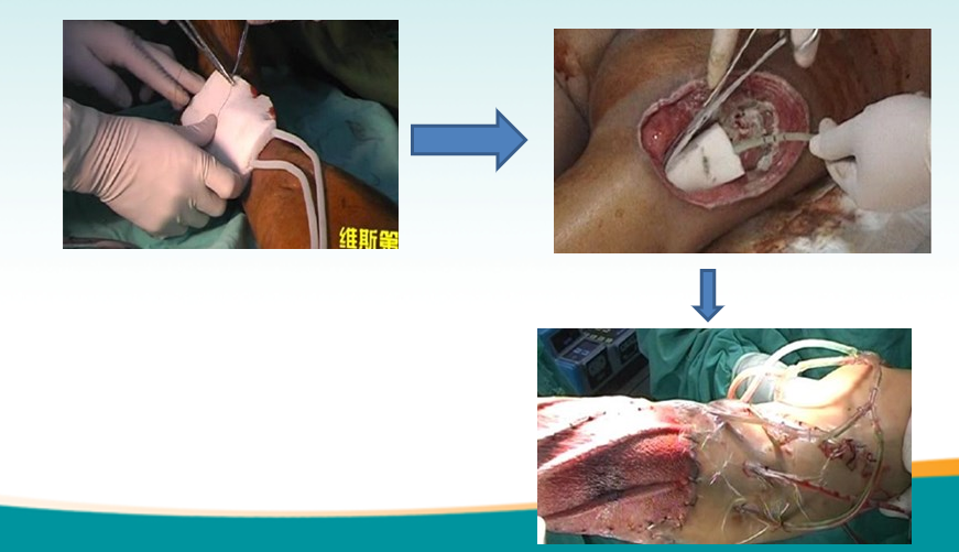 为什么负压引流骨科精读 ｜ 骨科常用的负压封闭引流术，一文读懂！_https://www.jmylbn.com_新闻资讯_第5张