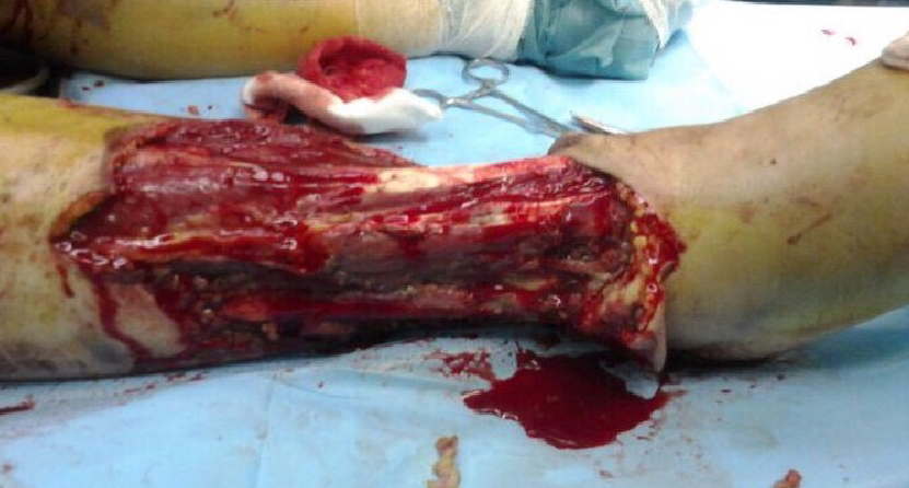 为什么负压引流骨科精读 ｜ 骨科常用的负压封闭引流术，一文读懂！_https://www.jmylbn.com_新闻资讯_第9张