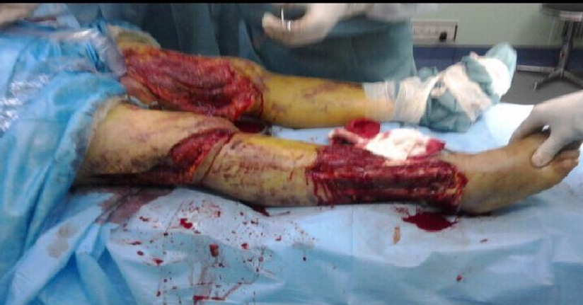 为什么负压引流骨科精读 ｜ 骨科常用的负压封闭引流术，一文读懂！_https://www.jmylbn.com_新闻资讯_第11张