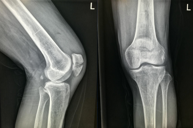 髌骨骨折图片x片图片