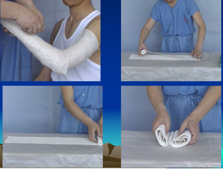 医用石膏夹板怎么软化关于骨折石膏固定技术总结及注意事项_https://www.jmylbn.com_新闻资讯_第3张