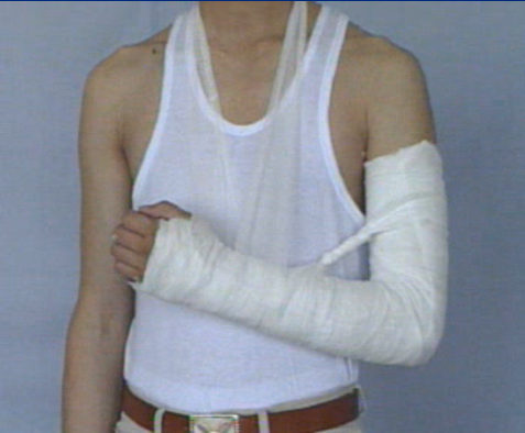 医用石膏夹板怎么软化关于骨折石膏固定技术总结及注意事项_https://www.jmylbn.com_新闻资讯_第7张