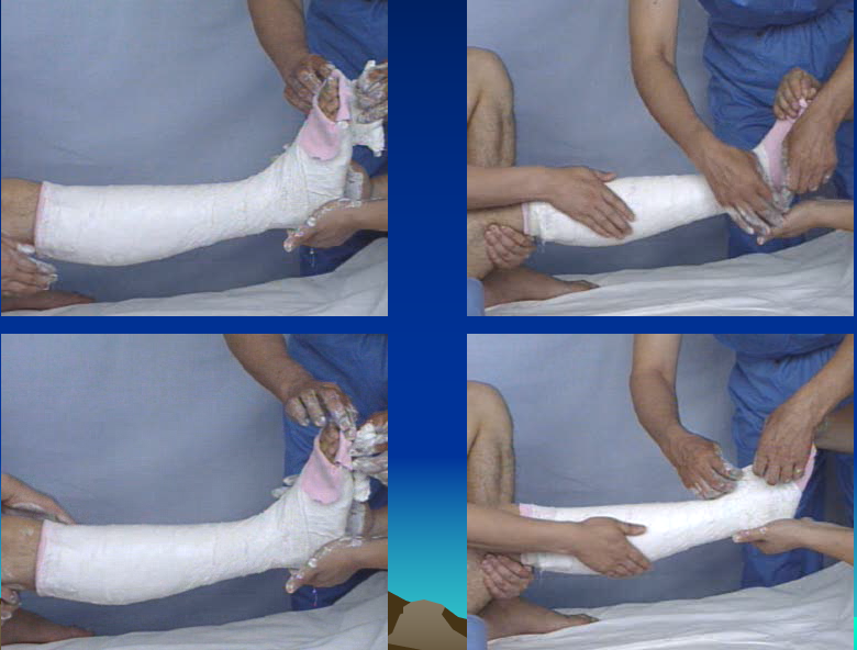 医用石膏夹板怎么软化关于骨折石膏固定技术总结及注意事项_https://www.jmylbn.com_新闻资讯_第8张