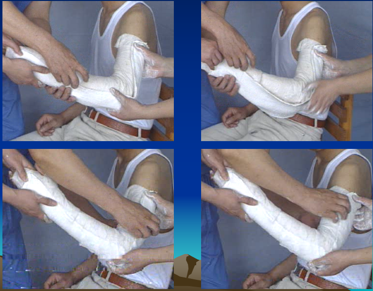 医用石膏夹板怎么软化关于骨折石膏固定技术总结及注意事项_https://www.jmylbn.com_新闻资讯_第6张