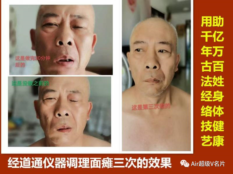 寒冬时节谨防面瘫找上门！“面瘫问题”该如何防治调护