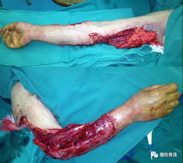 上肢严重开放伤—治疗技术与技巧