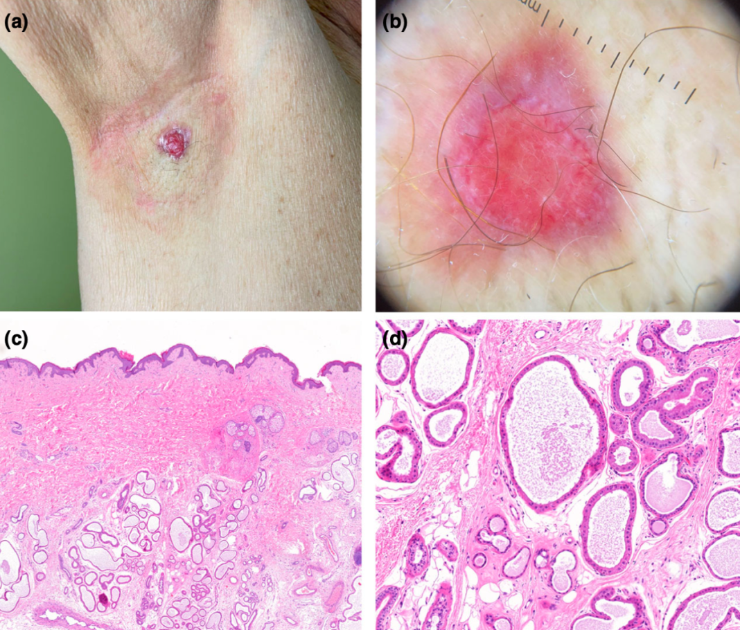 了局部扩大切除术,并对患者定期进行超声检查以随访淋巴结受累情况