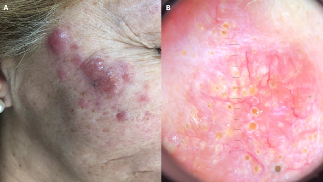 黄色角栓——原发性皮肤b细胞淋巴瘤,如何使用皮肤镜?_医学界-助力医