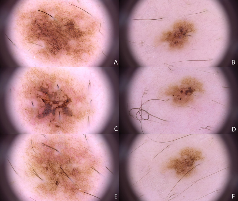 强脉冲光治疗后色素痣皮肤镜表现的改变