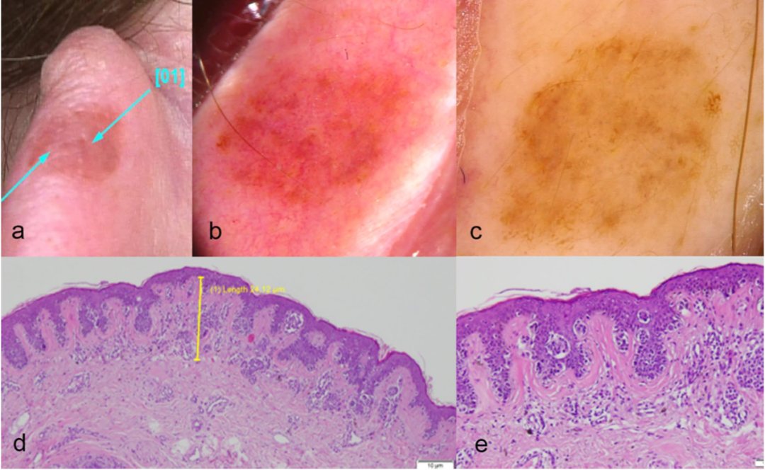 外耳黑色素瘤的皮膚鏡表現_醫學界-助力醫生臨床決策和職業成長