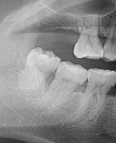 曲面断层片怎么看口腔精读 ｜ 一次性教你看懂曲面断层片！_https://www.jmylbn.com_新闻资讯_第43张