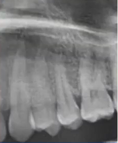 曲面断层片怎么看口腔精读 ｜ 一次性教你看懂曲面断层片！_https://www.jmylbn.com_新闻资讯_第59张