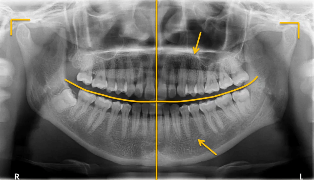 曲面断层片怎么看口腔精读 ｜ 一次性教你看懂曲面断层片！_https://www.jmylbn.com_新闻资讯_第7张