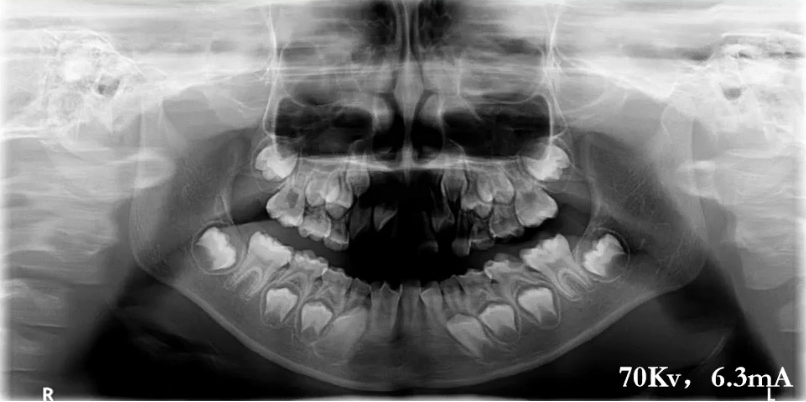 曲面断层片怎么看口腔精读 ｜ 一次性教你看懂曲面断层片！_https://www.jmylbn.com_新闻资讯_第17张