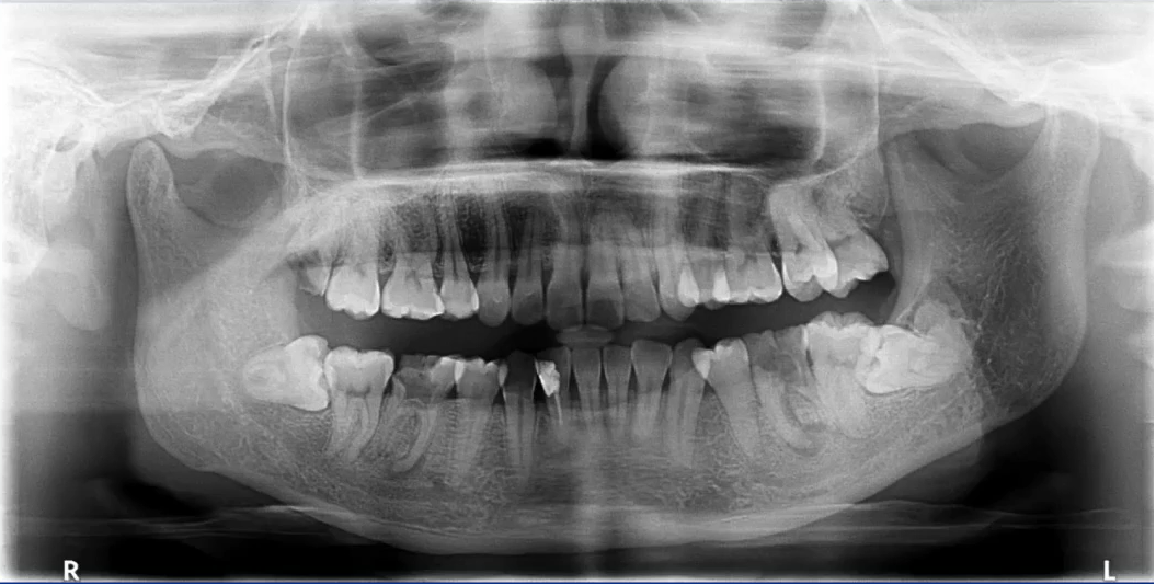 曲面断层片怎么看口腔精读 ｜ 一次性教你看懂曲面断层片！_https://www.jmylbn.com_新闻资讯_第45张