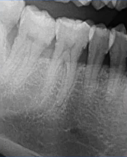 曲面断层片怎么看口腔精读 ｜ 一次性教你看懂曲面断层片！_https://www.jmylbn.com_新闻资讯_第36张