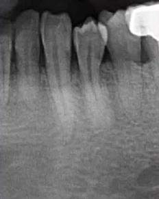 曲面断层片怎么看口腔精读 ｜ 一次性教你看懂曲面断层片！_https://www.jmylbn.com_新闻资讯_第40张