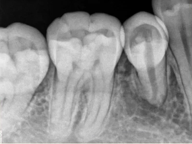 曲面断层片怎么看口腔精读 ｜ 一次性教你看懂曲面断层片！_https://www.jmylbn.com_新闻资讯_第26张