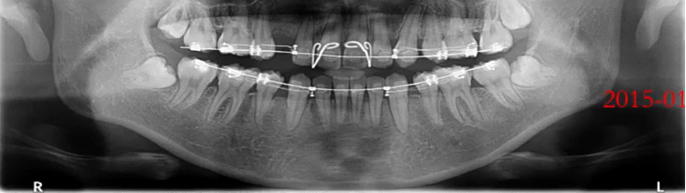 曲面断层片怎么看口腔精读 ｜ 一次性教你看懂曲面断层片！_https://www.jmylbn.com_新闻资讯_第13张