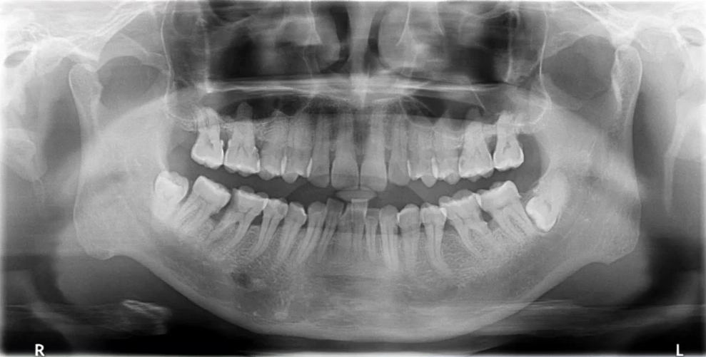 曲面断层片怎么看口腔精读 ｜ 一次性教你看懂曲面断层片！_https://www.jmylbn.com_新闻资讯_第9张