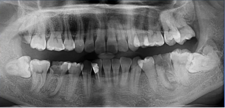 曲面断层片怎么看口腔精读 ｜ 一次性教你看懂曲面断层片！_https://www.jmylbn.com_新闻资讯_第46张