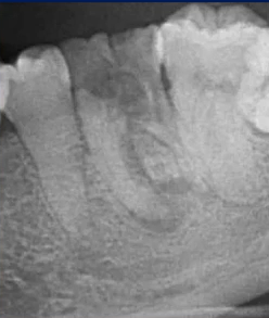 曲面断层片怎么看口腔精读 ｜ 一次性教你看懂曲面断层片！_https://www.jmylbn.com_新闻资讯_第49张