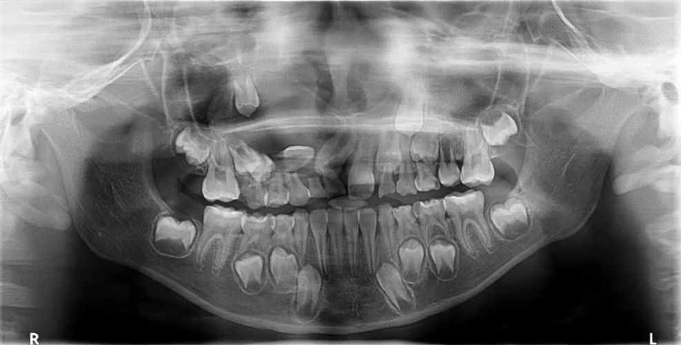 曲面断层片怎么看口腔精读 ｜ 一次性教你看懂曲面断层片！_https://www.jmylbn.com_新闻资讯_第28张