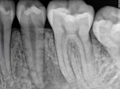 曲面断层片怎么看口腔精读 ｜ 一次性教你看懂曲面断层片！_https://www.jmylbn.com_新闻资讯_第21张