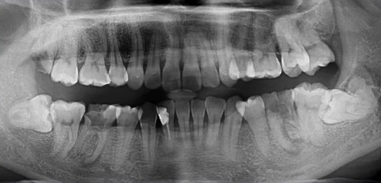 曲面断层片怎么看口腔精读 ｜ 一次性教你看懂曲面断层片！_https://www.jmylbn.com_新闻资讯_第47张