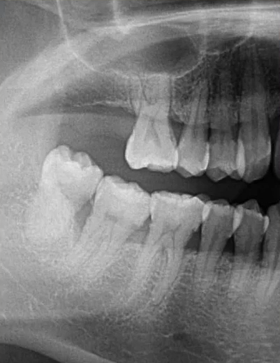 曲面断层片怎么看口腔精读 ｜ 一次性教你看懂曲面断层片！_https://www.jmylbn.com_新闻资讯_第31张