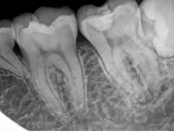 曲面断层片怎么看口腔精读 ｜ 一次性教你看懂曲面断层片！_https://www.jmylbn.com_新闻资讯_第56张