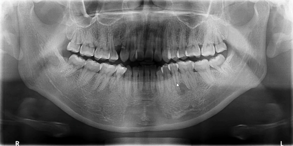 曲面断层片怎么看口腔精读 ｜ 一次性教你看懂曲面断层片！_https://www.jmylbn.com_新闻资讯_第20张