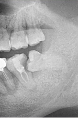 曲面断层片怎么看口腔精读 ｜ 一次性教你看懂曲面断层片！_https://www.jmylbn.com_新闻资讯_第33张