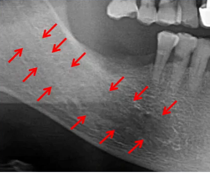 曲面断层片怎么看口腔精读 ｜ 一次性教你看懂曲面断层片！_https://www.jmylbn.com_新闻资讯_第64张