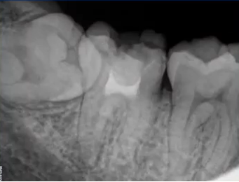 曲面断层片怎么看口腔精读 ｜ 一次性教你看懂曲面断层片！_https://www.jmylbn.com_新闻资讯_第54张