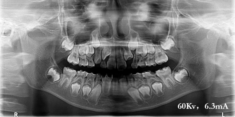 曲面断层片怎么看口腔精读 ｜ 一次性教你看懂曲面断层片！_https://www.jmylbn.com_新闻资讯_第18张