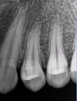 曲面断层片怎么看口腔精读 ｜ 一次性教你看懂曲面断层片！_https://www.jmylbn.com_新闻资讯_第58张