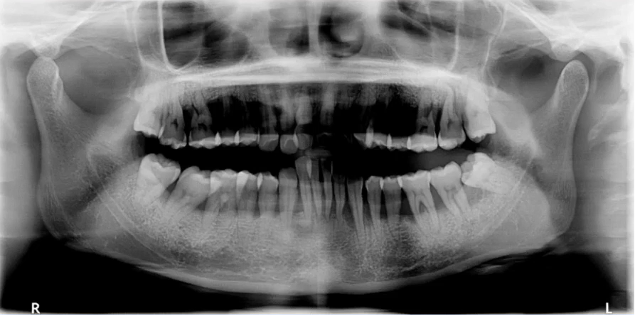 曲面断层片怎么看口腔精读 ｜ 一次性教你看懂曲面断层片！_https://www.jmylbn.com_新闻资讯_第11张