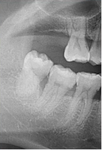 曲面断层片怎么看口腔精读 ｜ 一次性教你看懂曲面断层片！_https://www.jmylbn.com_新闻资讯_第32张