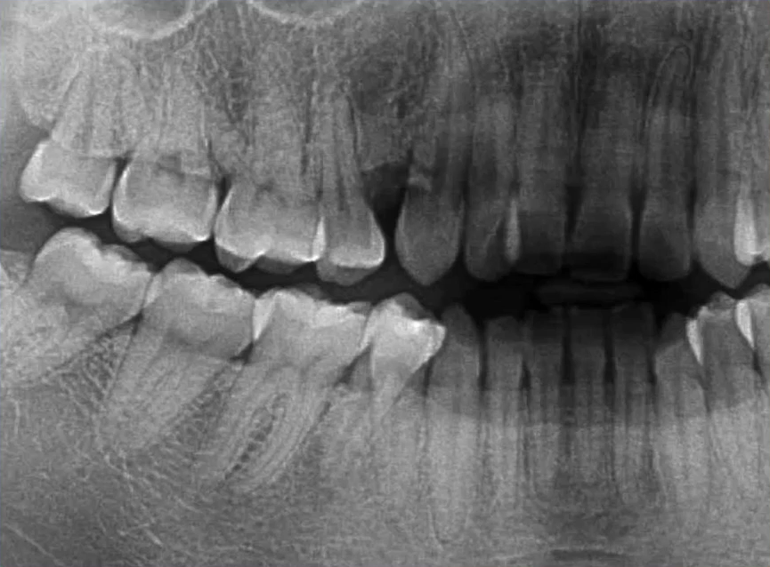 曲面断层片怎么看口腔精读 ｜ 一次性教你看懂曲面断层片！_https://www.jmylbn.com_新闻资讯_第22张