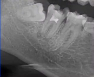 曲面断层片怎么看口腔精读 ｜ 一次性教你看懂曲面断层片！_https://www.jmylbn.com_新闻资讯_第55张