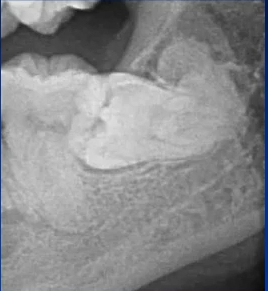 曲面断层片怎么看口腔精读 ｜ 一次性教你看懂曲面断层片！_https://www.jmylbn.com_新闻资讯_第51张