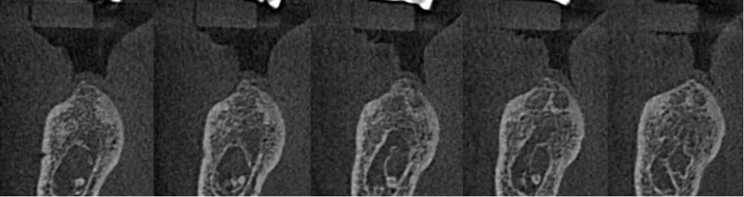 曲面断层片怎么看口腔精读 ｜ 一次性教你看懂曲面断层片！_https://www.jmylbn.com_新闻资讯_第69张